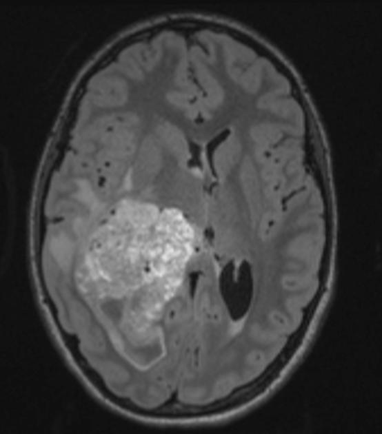 Carcinoma MRI example