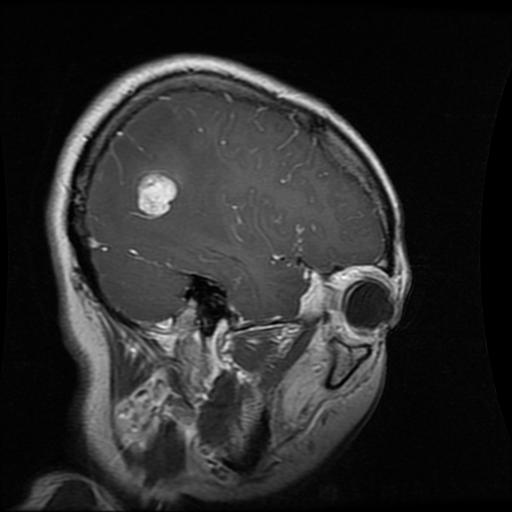 Glioma MRI example