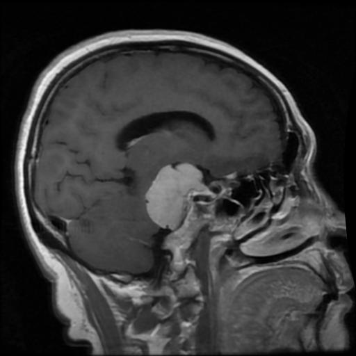 Meningioma MRI example