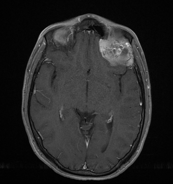 Neurocytoma MRI example