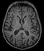 Healthy brain MRI example