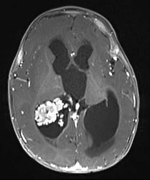 Papilloma MRI example
