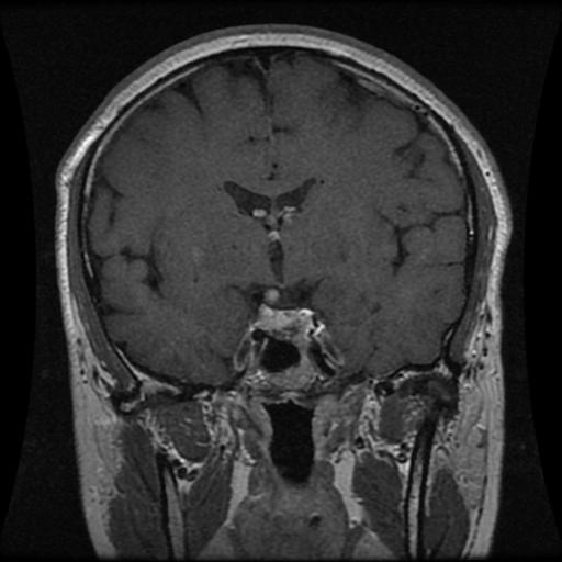 Pituitary tumor MRI example
