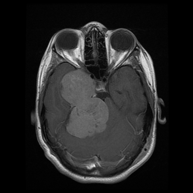 Schwannoma MRI example